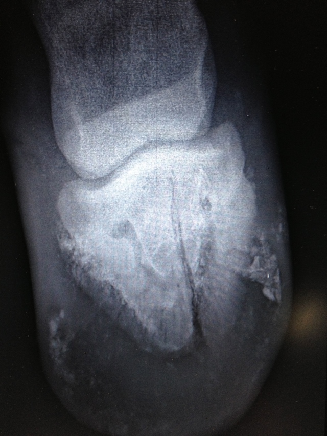 pedal bone fracture